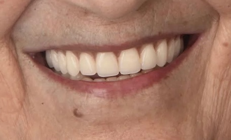Nouveau sourire, nouvelle vie - Transformation 2